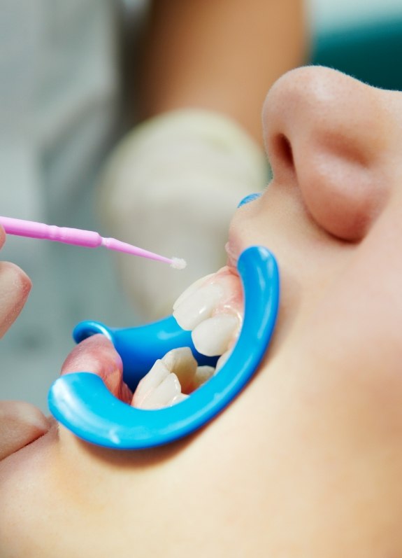 Close up of child having fluoride applied to their teeth