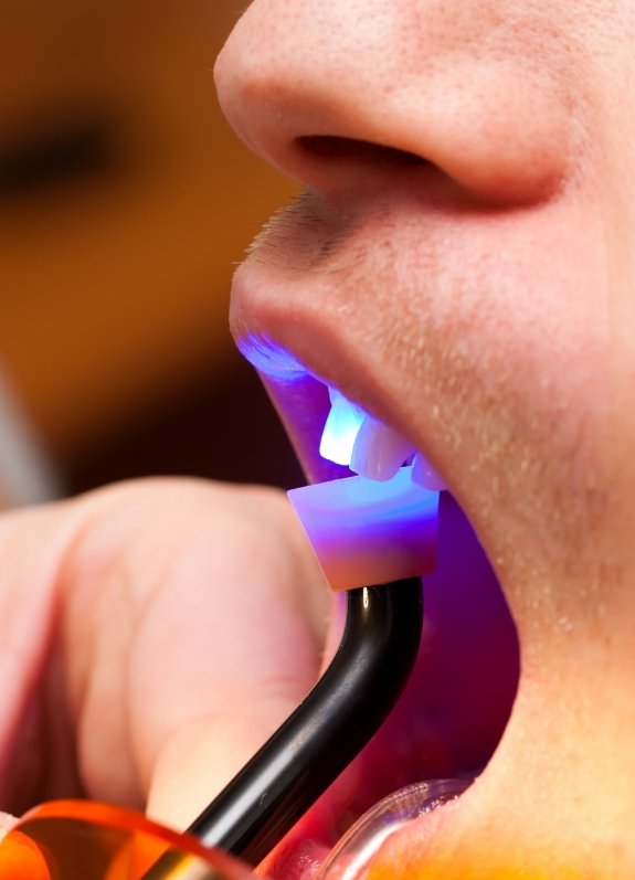 Close up of dental patient receiving cosmetic bonding on upper front tooth