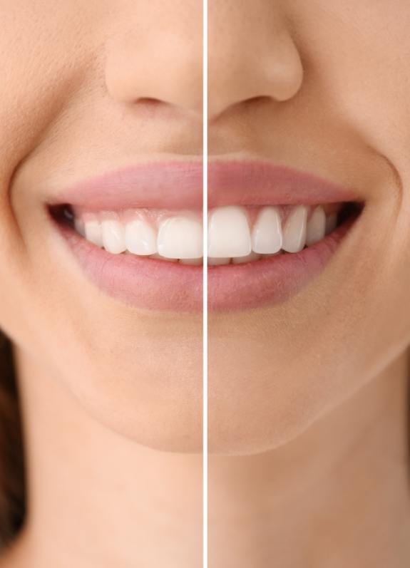 Close up of smile before and after gum recontouring