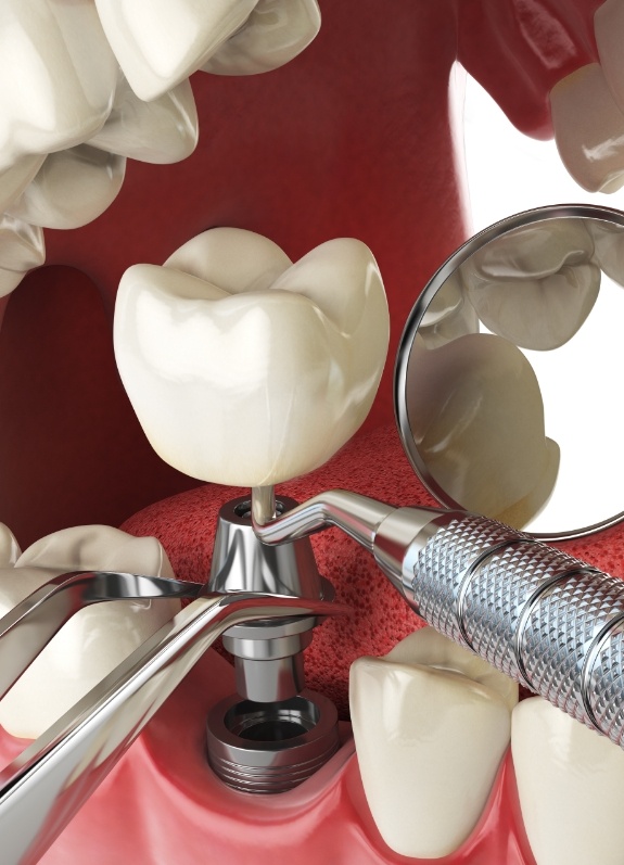 Illustrated dental implant being placed into the lower jaw