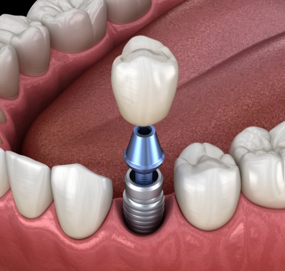 Illustrated dental crown being fitted onto a dental implant