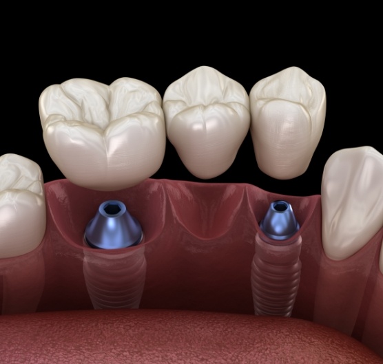 Illustrated dental bridge being fitted onto two dental implants