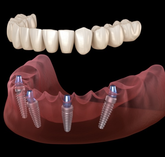 Illustrated full denture being fitted onto four dental implants