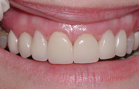 Smile with properly aligned teeth