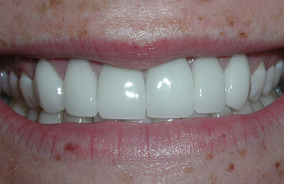 Smile after teeth whitening