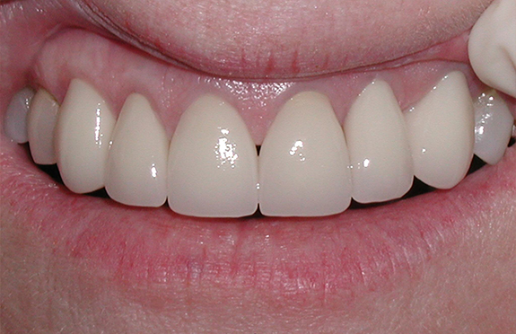 Smile with flawless teeth after cosmetic dentistry