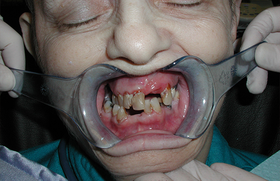 Senior woman with several missing and damaged teeth