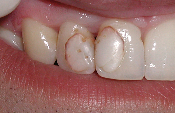 Close up of row of severely stained and chipped teeth