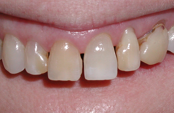 Smile with gapped stained and misshapen teeth