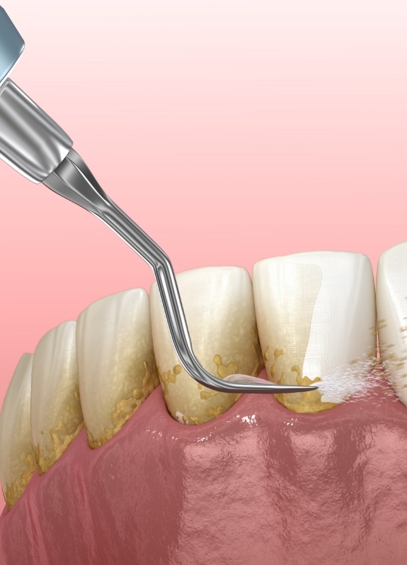 Illustrated dental scaler removing plaque buildup from teeth