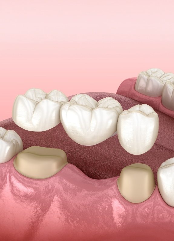 Illustrated dental bridge replacing a missing tooth