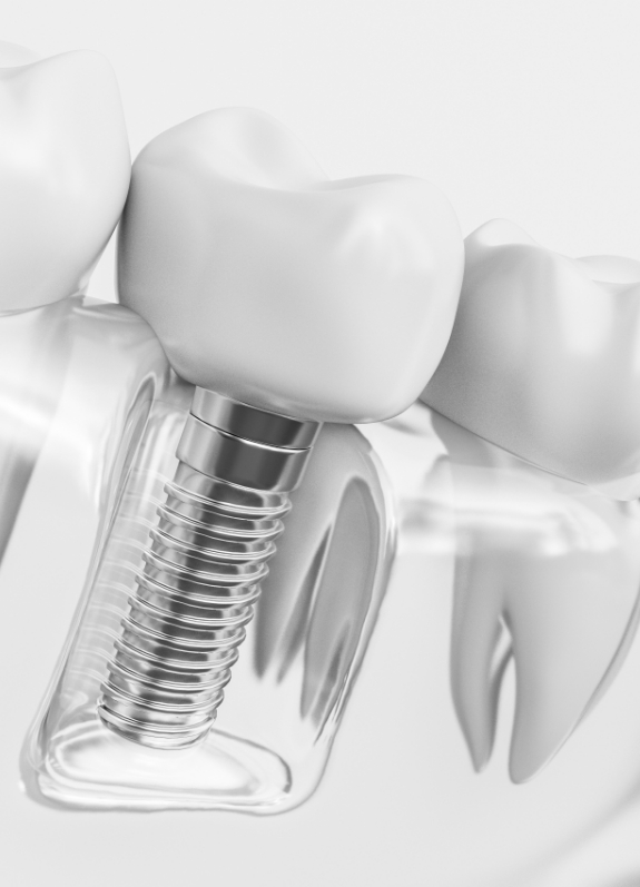 Illustrated model of mouth with dental implant replacing a missing lower tooth