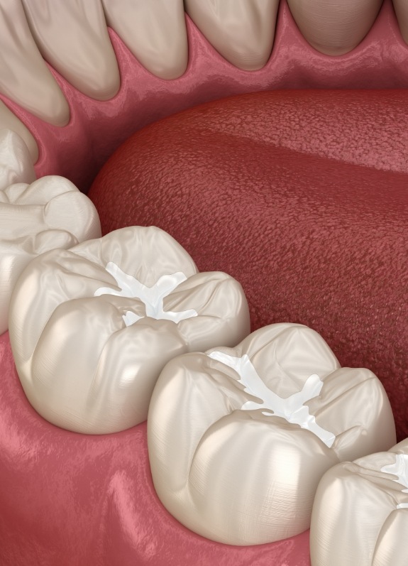 Illustrated row of teeth with white fillings