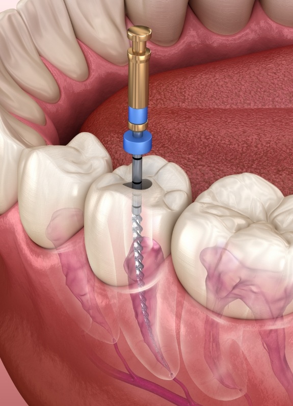Illustrated dental instrument treating inside of tooth