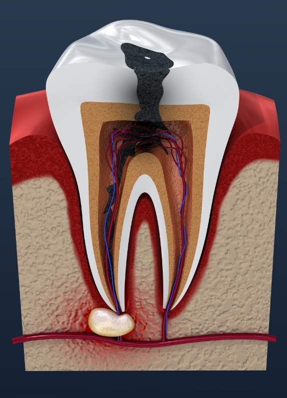 Illustration of severely decayed tooth
