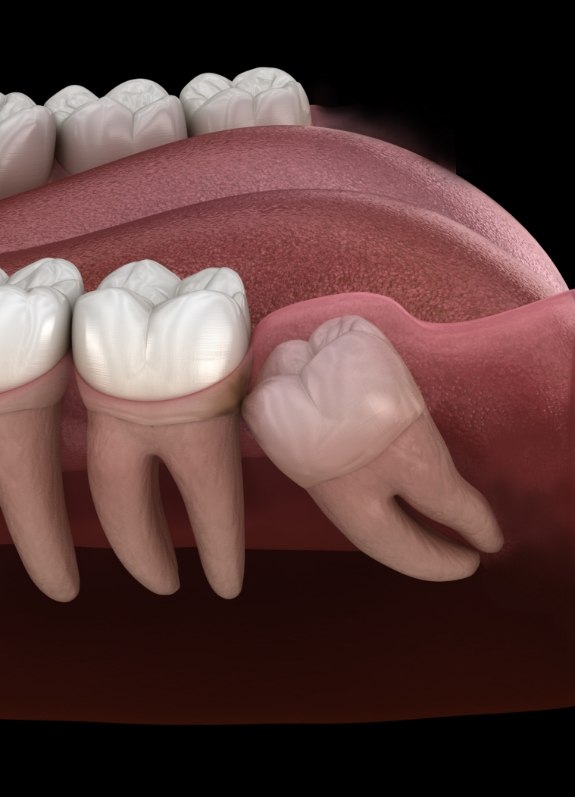 Illustrated wisdom tooth pressing against adjacent tooth